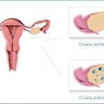 Inositolo: l’integratore efficace contro la sindrome dell’ovaio policistico